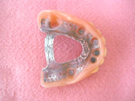 磁性アタッチメント義歯のイメージ